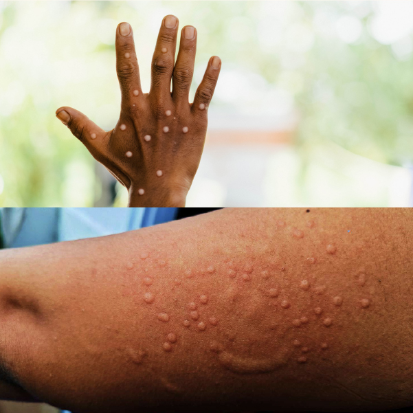 Monkeypox In Nigeria 2024 Everything You Need To Know About The