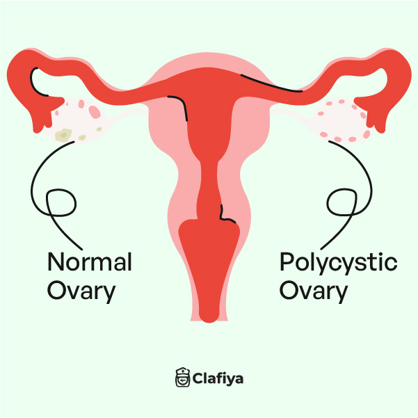 Everything You Need To Know About PCOS In 2024
